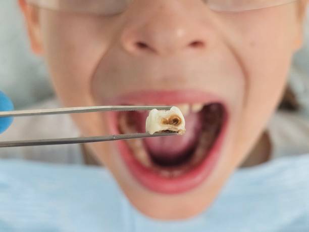 Best Emergency Tooth Extraction in Mont Belvieu, TX